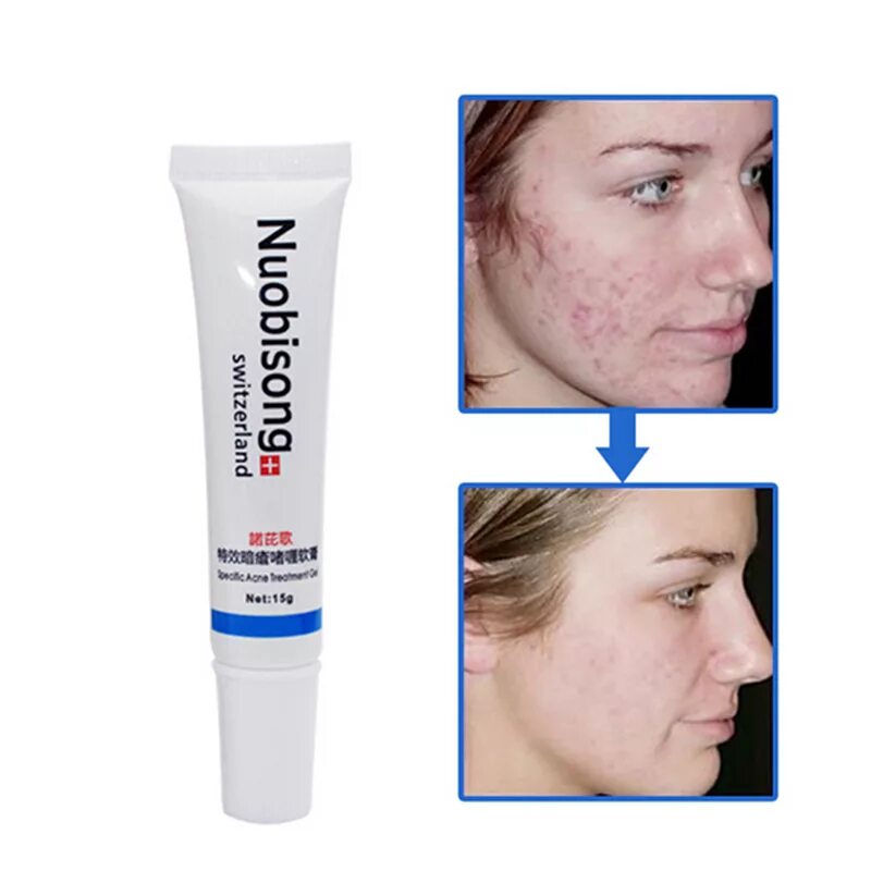 Крем acne scar removal от прыщей. Крем мазь от шрамов акне на лице.