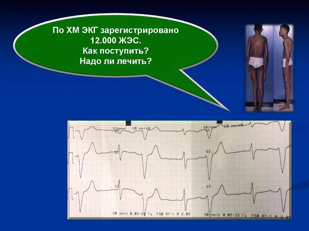 ЖЭС на ЭКГ. ЭКГ при ЖЭС. ЖЭС ЭКГ презентация. ЖЭС на ЭКГ расшифровка.