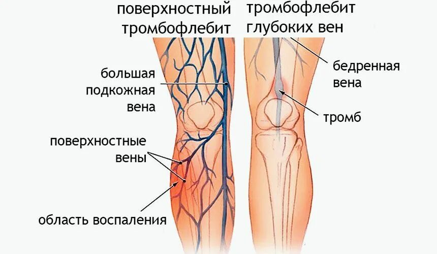 Ноет нога выше колена. Поверхностный флебит, тромбофлебит. Острый тромбоз глубоких вен нижних конечностей. Послеродовый тромбофлебит вен.