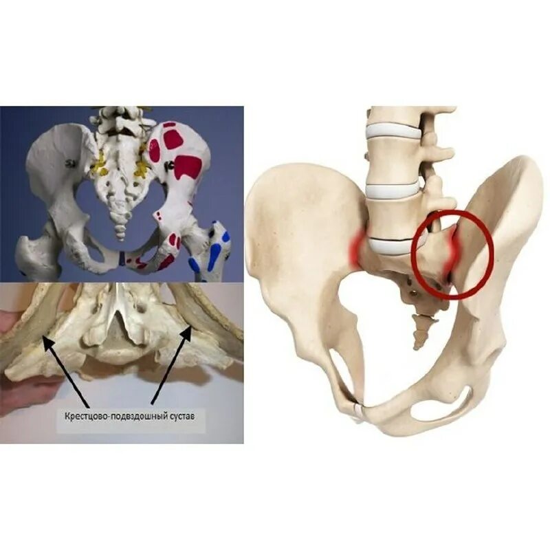 Остеофит бедренной кости. Врождённый вывих бедра у детей. Тбс тазобедренного сустава. Остеотомия таза (периацетабулярная, тройная). Вертельная сумка тазобедренного сустава анатомия.