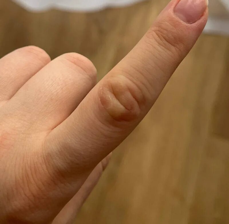 трещины на указательном пальце. наростыши на фалангах пальцев рук. припухлость на суставе пальца. на сгибе указательного пальца. шишка на указательном пальце руки.