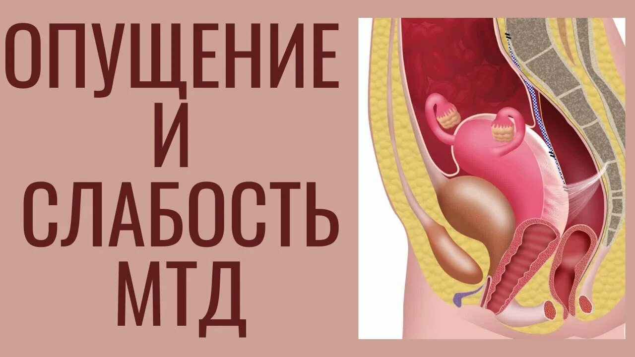 Пролапс органов малого таза. Опущение тазовых органов у женщин. Операция опущение матки лечение