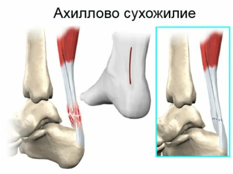 Почему болят сухожилия пятки. Ахиллово сухожилие тендинит. Ахиллово сухожилие растяжение. Отрыв ахиллесова сухожилия. Перитендинит ахиллова сухожилия.