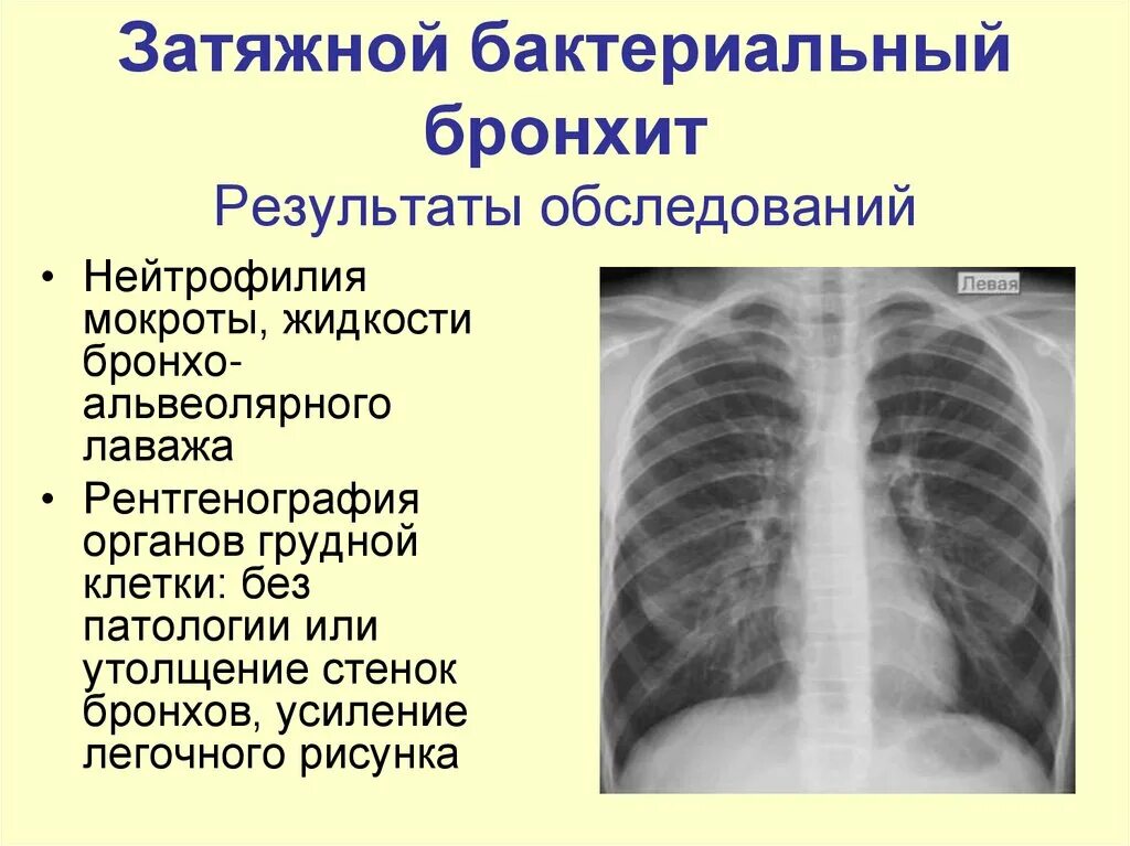 Рентген признаки бронхита у детей. Рентгенография острого бронхита. Симптомы при бронхите.