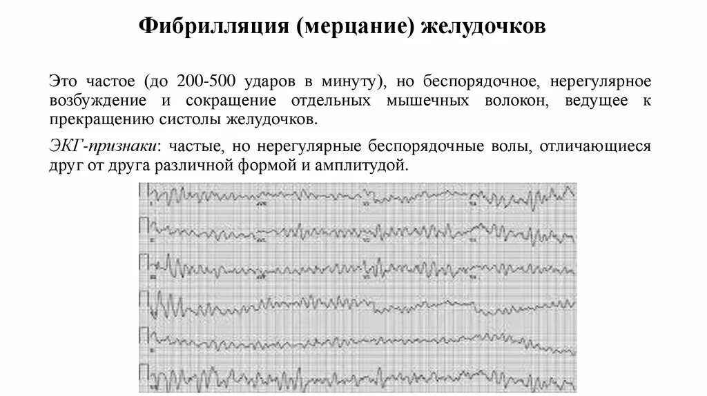 Фибрилляция желудочков на ЭКГ. Трепетание желудочков на ЭКГ. Трепетание и фибрилляция желудочков на ЭКГ. Трепетание и мерцание (фибрилляция) желудочков.