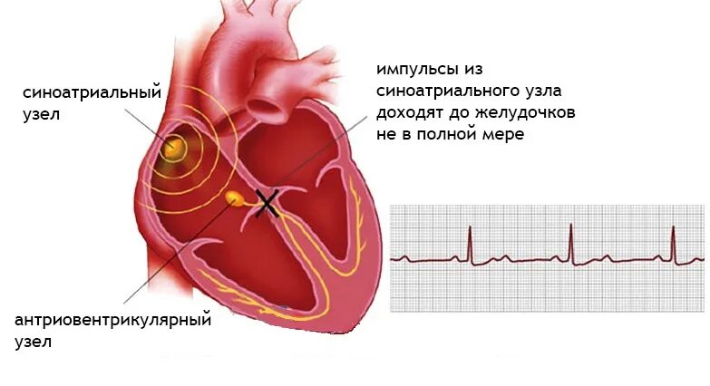 Блокада узла. Блокада проводимости сердца. Блокада проводящей системы сердца ЭКГ. Атриовентрикулярной блокадой сердца. Проводящая система сердца при АВ блокаде.