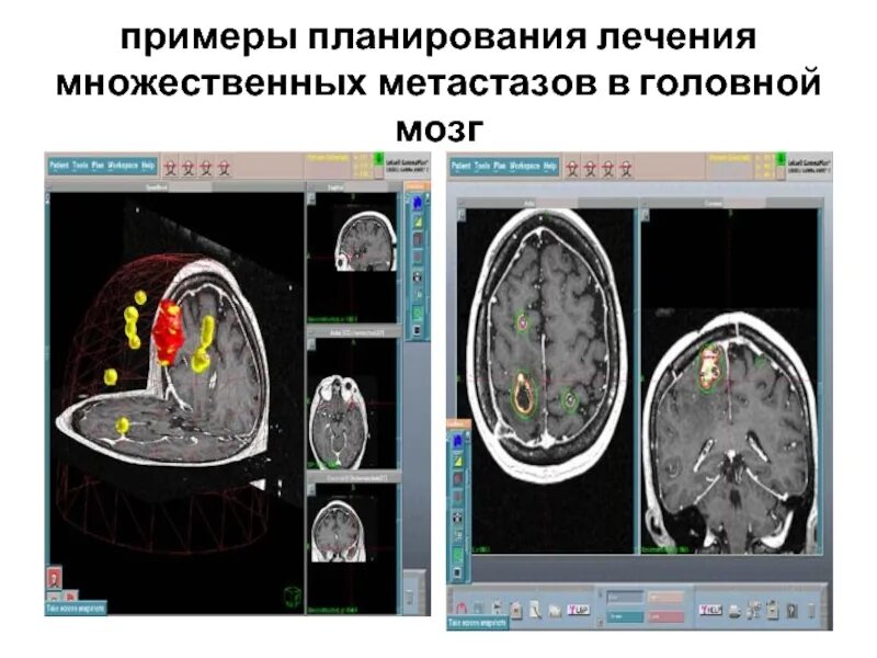 Лечение метастазов мозга. Гамма нож на головном мозге. Стереотаксическая радиохирургия. Стереотаксическая радиохирургия (SRS). Гамма нож при метастазах в головном мозге.