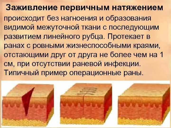 Сколько заживает глубокий. Первичное и вторичное натяжение заживление РАН. Заживление раны первичным натяжением. Зажиалпние первычным гатчжением. Заживление РАН вторичным натяжением.