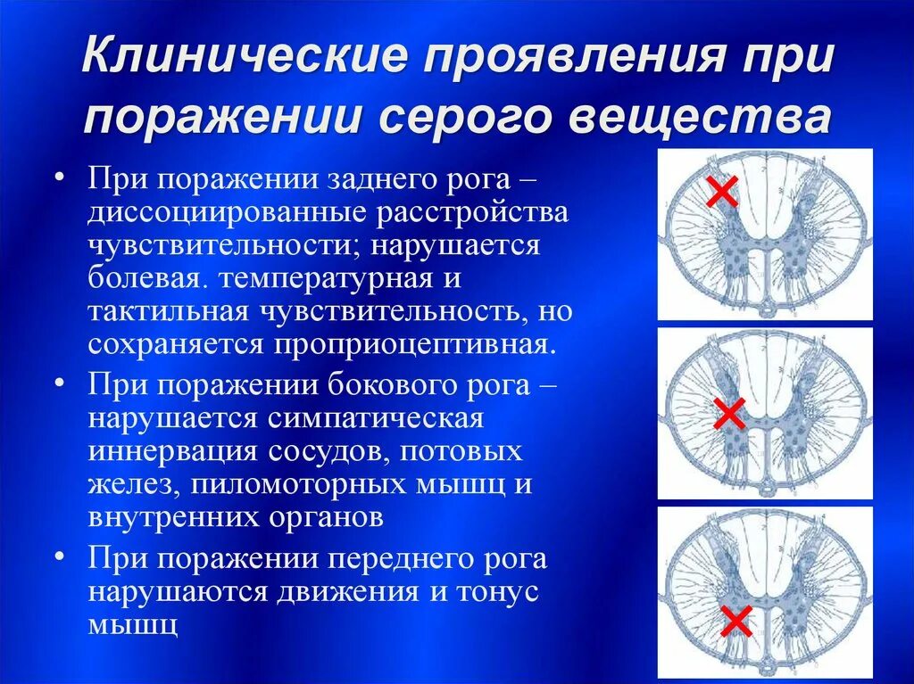 Задний рог серого вещества спинного мозга. Поражение заднего рога спинного мозга. Синдром поражения заднего рога спинного мозга. Синдром серого вещества. Поражение серого вещества спинного мозга.