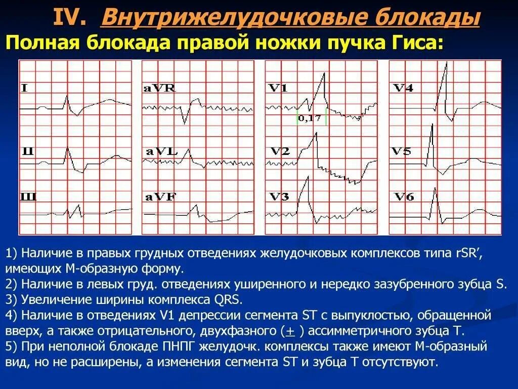 Блокада правого желудочка. Внутрижелудочковая блокада левой ножки пучка Гиса ЭКГ. Внутрижелудочковая блокада на ЭКГ. Внутрижелудочковая блокада ЭКГ признаки. Внутрижелудочковая блокада. Блокада левой ножки пучка Гиса..