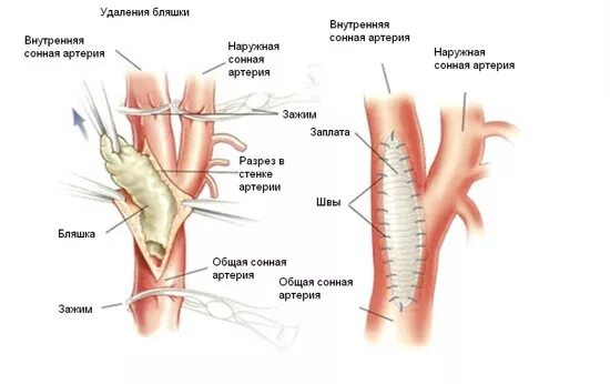 Артерия тромб удаление