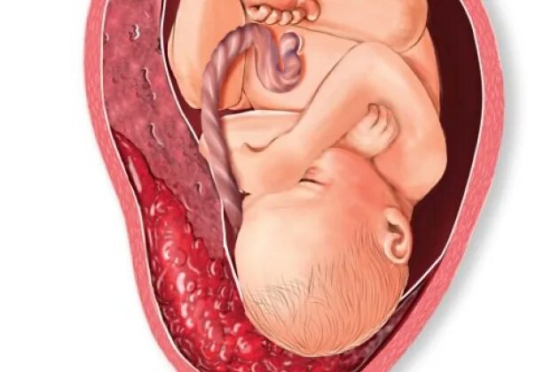 Отслойка 8 недель. Отслойка плаценты кровотечение. Субамниотическая отслойка плаценты.