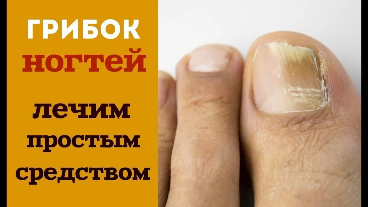 Как вылечить ногтевую