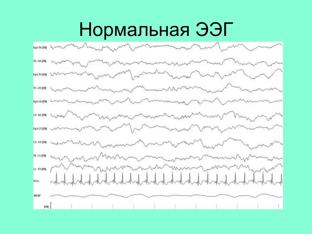 Нормальная ээг