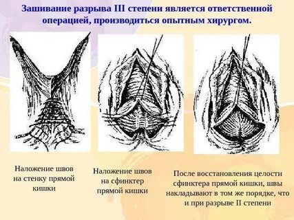 Как зашивают после родов