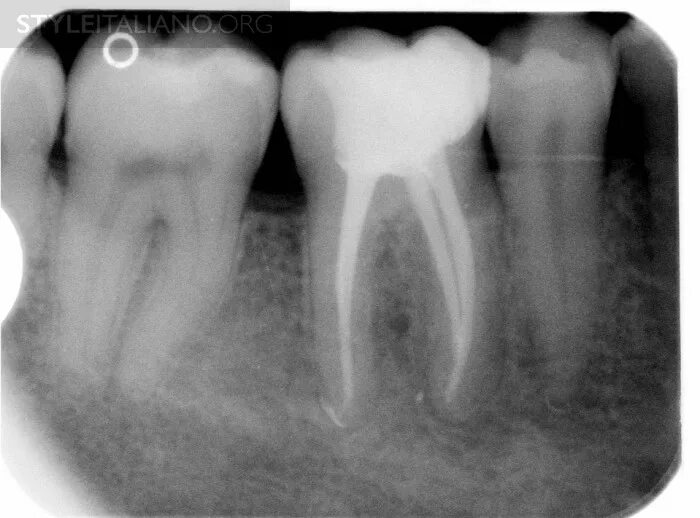 Восстановление после эндодонтического лечения. Снимки запломбированных корневых каналов. Запломбированный канал в зубе снимок.