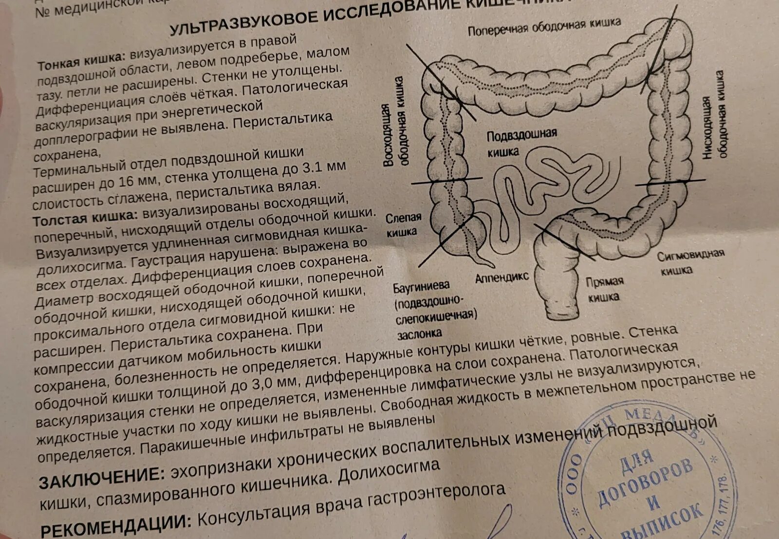 Узи кишок что это. Узи кишок что это. Свободная жидкость в брюшной полости. Инвагинация толстой кишки узи. Узи острая кишечная непроходимость.