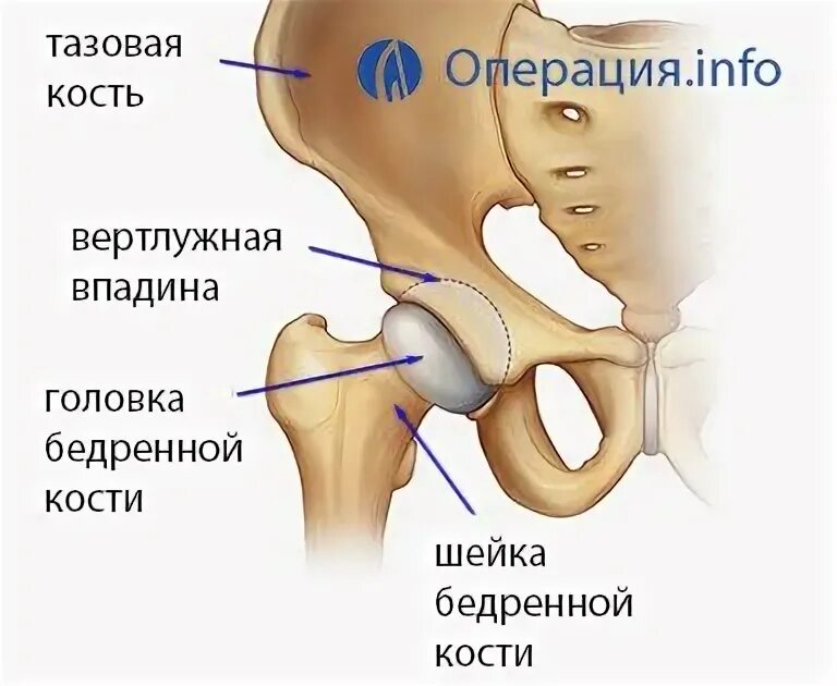 Шейка бедра операция отзывы. Вертлужная впадина кости. Операции при переломе шейка бедра. Тазобедренный перелом шейки бедра. Вертлужная кость тазобедренного сустава.