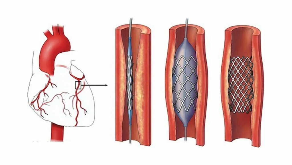 Стент после операции. Коронарное стентирование. Стентирование коронарных артерий схема. Коронарное стентирование сосудов сердца. Коронарная ангиопластика и стентирование.
