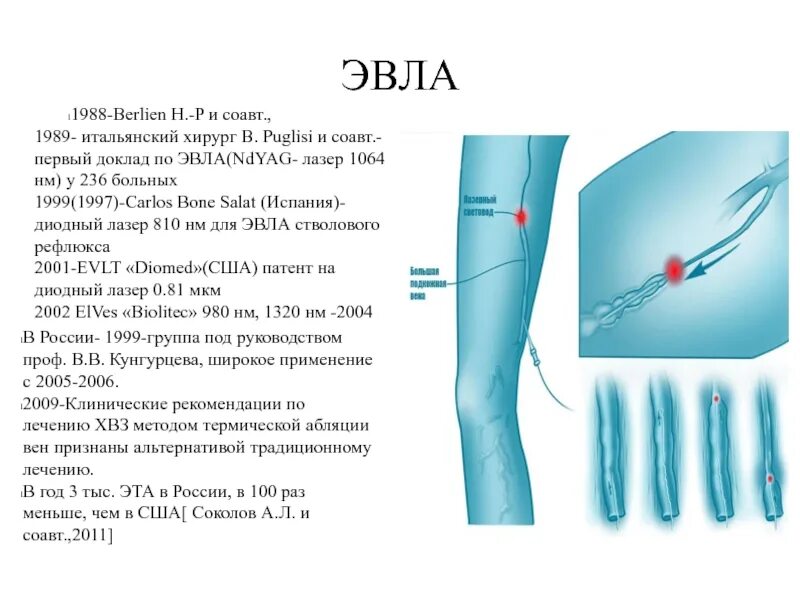 Эндовазальная лазерная коагуляция вен. Эндовенозная лазерная облитерация (коагуляция).. Эндовазальная лазерная облитерация вен.