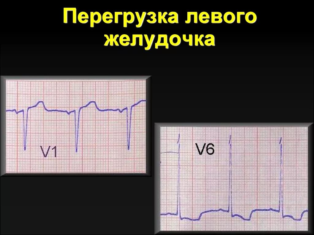 Глж на экг что это значит. Гипертрофия миокарда перегрузка левого желудочка ЭКГ. Систолическая перегрузка левого желудочка на ЭКГ. ЭКГ при гипертрофии левого желудочка с систолической перегрузкой. Перегрузка желудочков на ЭКГ.