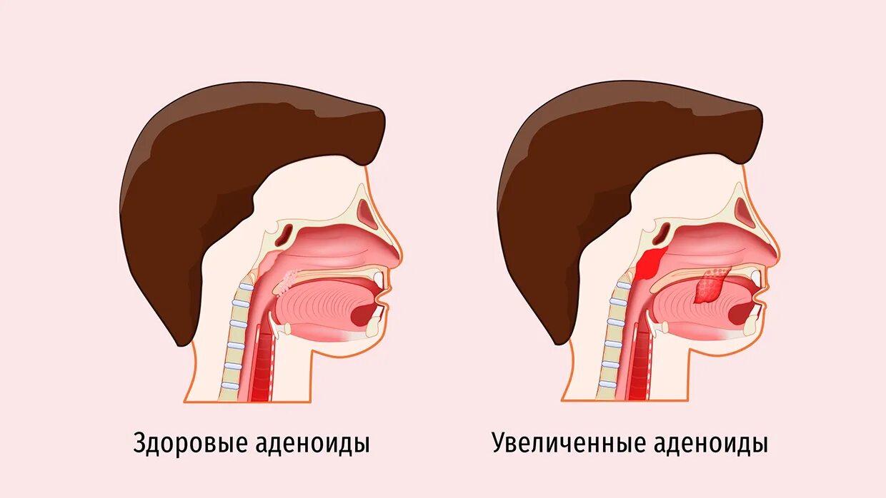 Анатомия ЛОР органов аденоиды.