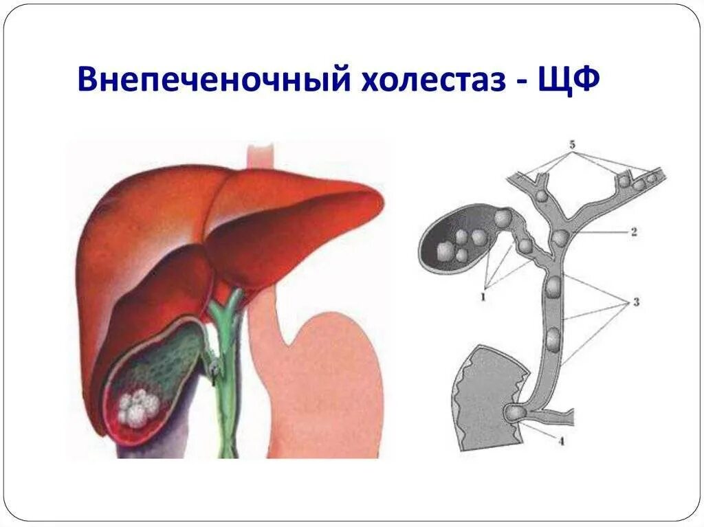 Желчный пузырь застой отзывы