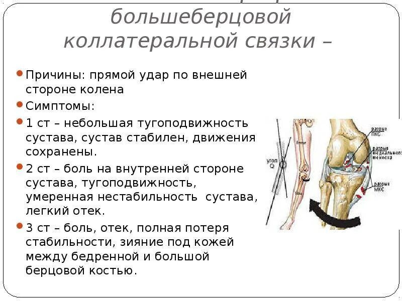 Латеральная коллатеральная связка коленного. Коллатеральная связка коленного сустава. Симптомы повреждения коллатеральной связки коленного сустава. Повреждения латеральной боковой связки колена. Травмы боковых связок коленного сустава.