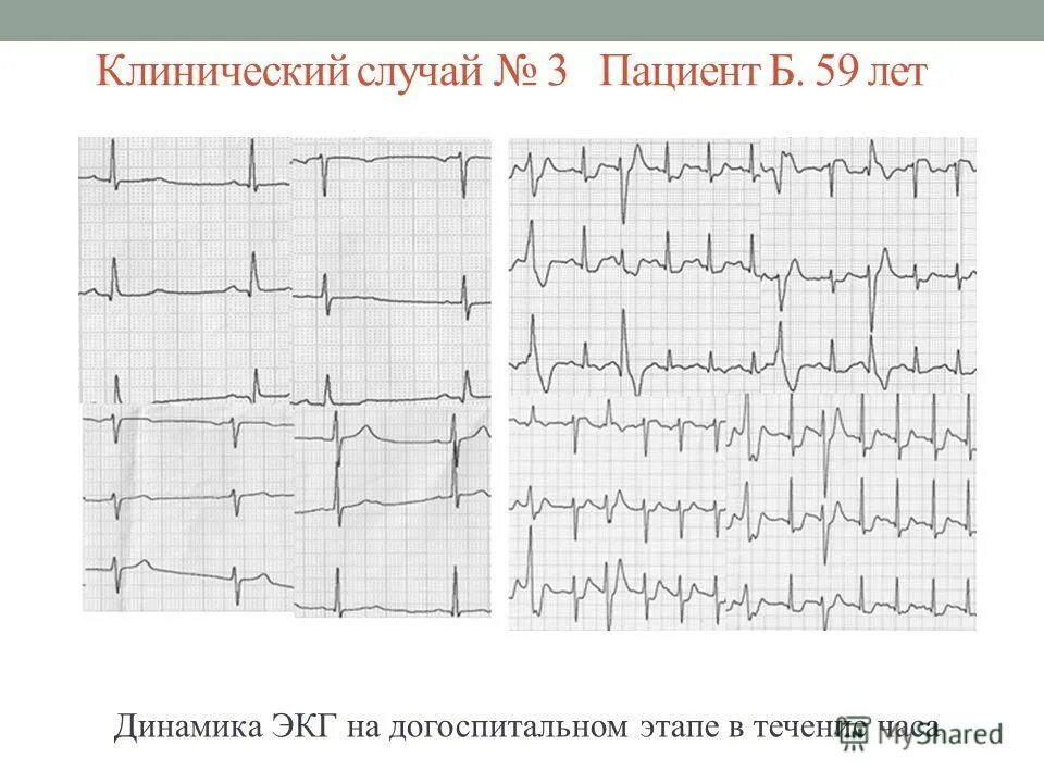 аневризма аорты симптомы экг. аневризма на экг. экг при аневризме левого желудочка экг. аневризма лж на экг. застывшая экг при аневризме сердца.