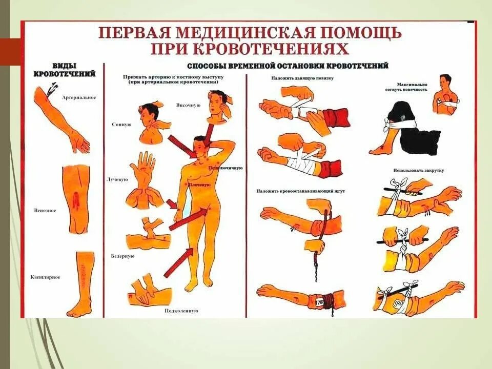 Памятка ПМП при артериальном кровотечении. Способы временной остановки артериального кровотечения ПМП. Виды РАН, виды кровотечения и способы остановки кровотечения. Кровотечения и правила оказания первой помощи при кровотечениях..