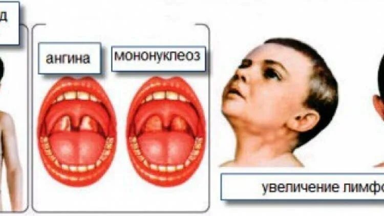 Сыпь лимфоузлы температура