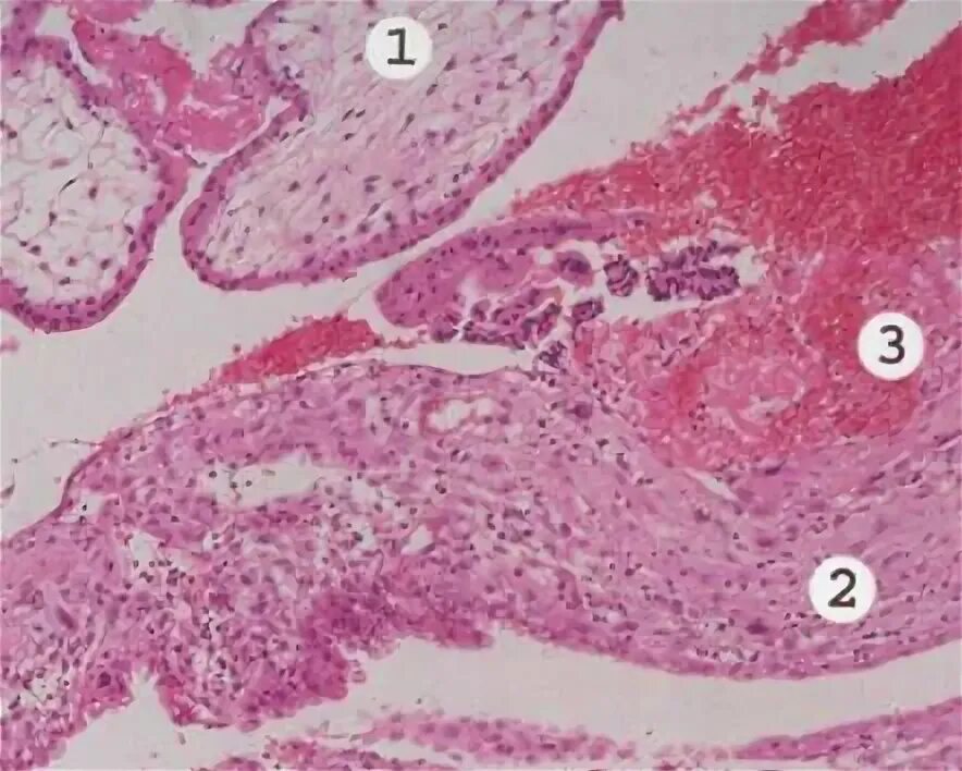 Гистология при беременности. Децидуальная ткань гистология. Децидуальная ткань микропрепарат. Децидуальная ткань это патанатомия. Децидуальная ткань с очагами фибриноидного некроза.