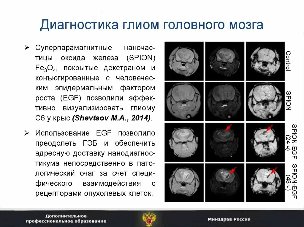 Глиоматоз головного мозга Продолжительность жизни. Глиома мозгового ствола. Глиома ствола мозга мрт. Диагноз опухоли головного