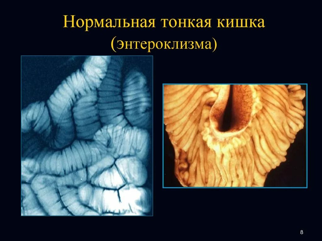 Образования тонкой кишки. Тонкий кишечник строение анатомия. Исследование тонкого кишечника. Снимок тонкого кишечника.