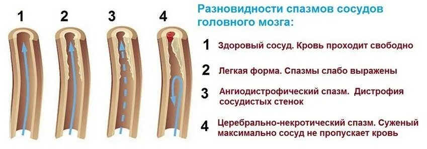Сужение периферических сосудов. Лекарство для чистки сосудов мозга. Сосудистый спазм головного мозга. Спазм сосудов головного мозга симптомы. Успокоить сосуды.