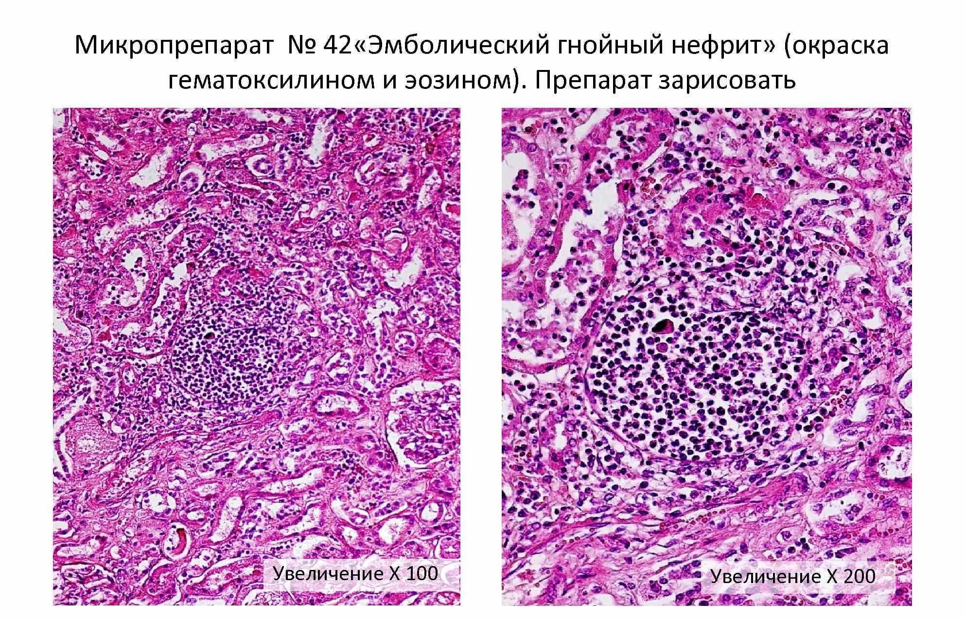 Пиелонефрит микропрепарат. Эмболический Гнойный нефрит макропрепарат. Эмболический Гнойный нефрит патанатомия. Эмболический Гнойный нефрит патанатомия макропрепарат. ГНОЙНИЧКОВЫЙ нефрит микропрепарат.
