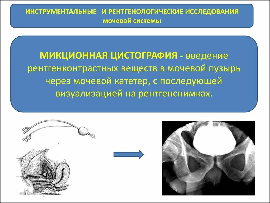 Рентгенологическое исследование мочевого пузыря. Микционная цистография мочевого пузыря. Рентгеноконтрастное исследование мочевого пузыря. Операция шейки мочевого пузыря