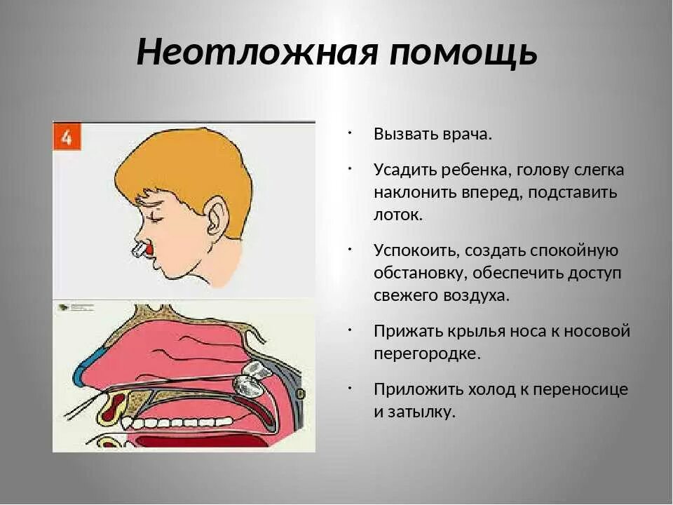 Нлсовоеткровоьечение у детей. Остановка носового кровотечения алгоритм. Остановка родового кровотечения.