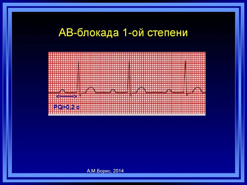 Блокада сердца опасно для жизни. АВ блокада препараты. Внутрипредсердная блокада степени. Внутрипредсердная блокада 1 степени. АВ-блокада 2-Ой степени 2:1.