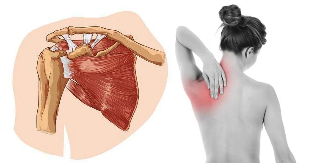 Почему может болеть лопатка. Подлопаточная невралгия. Болит лопатка. Боль под лопаткой. Защемление нервов под лапоткой.