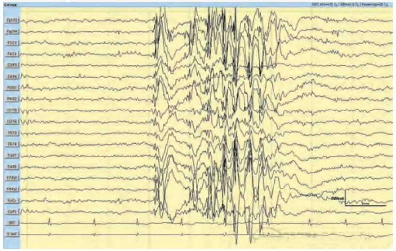Юношеская миоклоническая эпилепсия ЭЭГ. Миоклонус эпилепсия на ЭЭГ. Юношеская абсанс эпилепсия ЭЭГ. Джексоновская эпилепсия на ЭЭГ. Юношеская эпилепсия