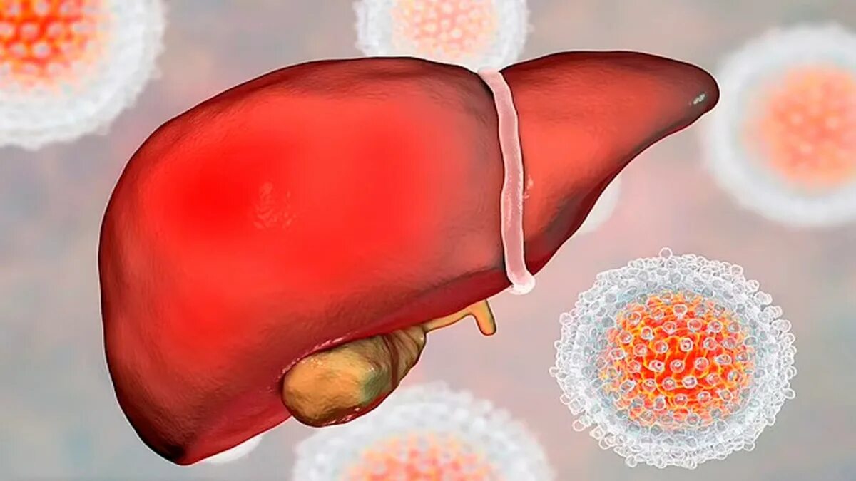Вирусный гепатит печень. Печень пораженная гепатитом.
