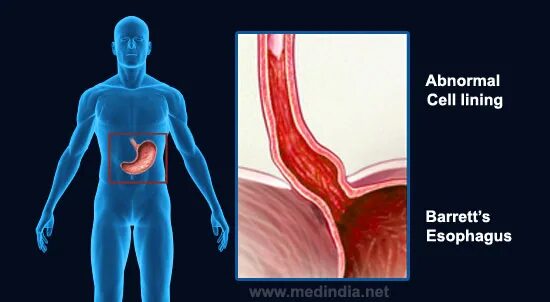 Баретта пищевод Барретта что это. Пищевод Барретта классификация. Как выглядит пищевод Барретта.