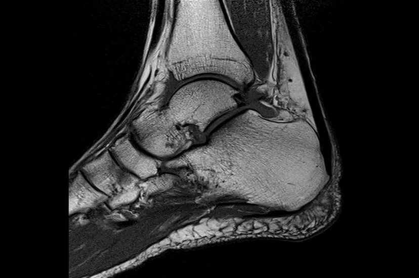 Разрыв связок голеностопного сустава мрт. Хондроматоз голеностопного сустава. Повреждение связок голеностопного сустава мрт. Хондрома голеностопного сустава мрт.