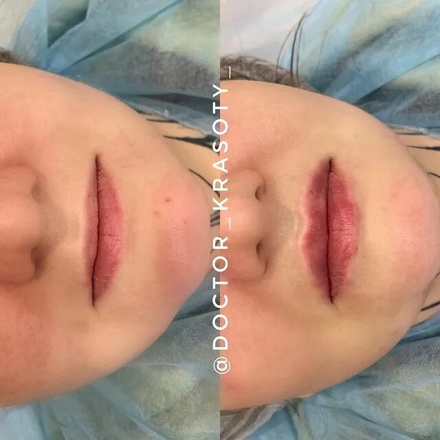 накачивание губ гиалуроновой кислотой 1 мл. косметолог губы спб. косметолог губы спб. косметолог губы спб. контурная пластика губ после заживления.