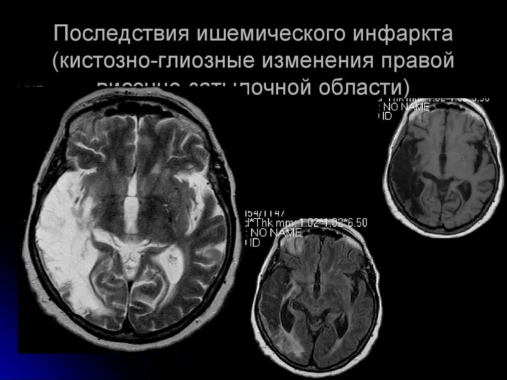 Глиозные изменения лобной доли