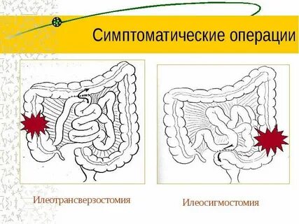 Операция на кишечнике отзывы