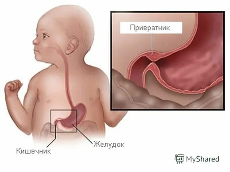 Пищевод у новорожденного. Пилороспазм и пилоростеноз у детей. Врожденный гипертрофический пилоростеноз. Гипертрофический пилоростеноз у новорожденных. Врожденный пилоростеноз новорожденных.