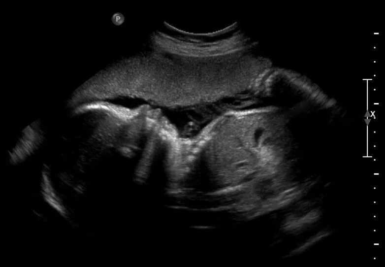 Синдром 3 триместра. Ультразвуковое исследование плода 3 триместр. УЗИ 3 триместр беременности.