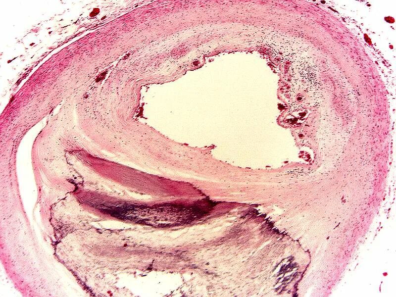 На фоне фиброзных изменений. Атеросклероз аорты препарат патанатомия. Атеросклероз аорты гистология. Атеросклероз сосудов патанатомия. Атеросклероз сосудов макропрепарат.